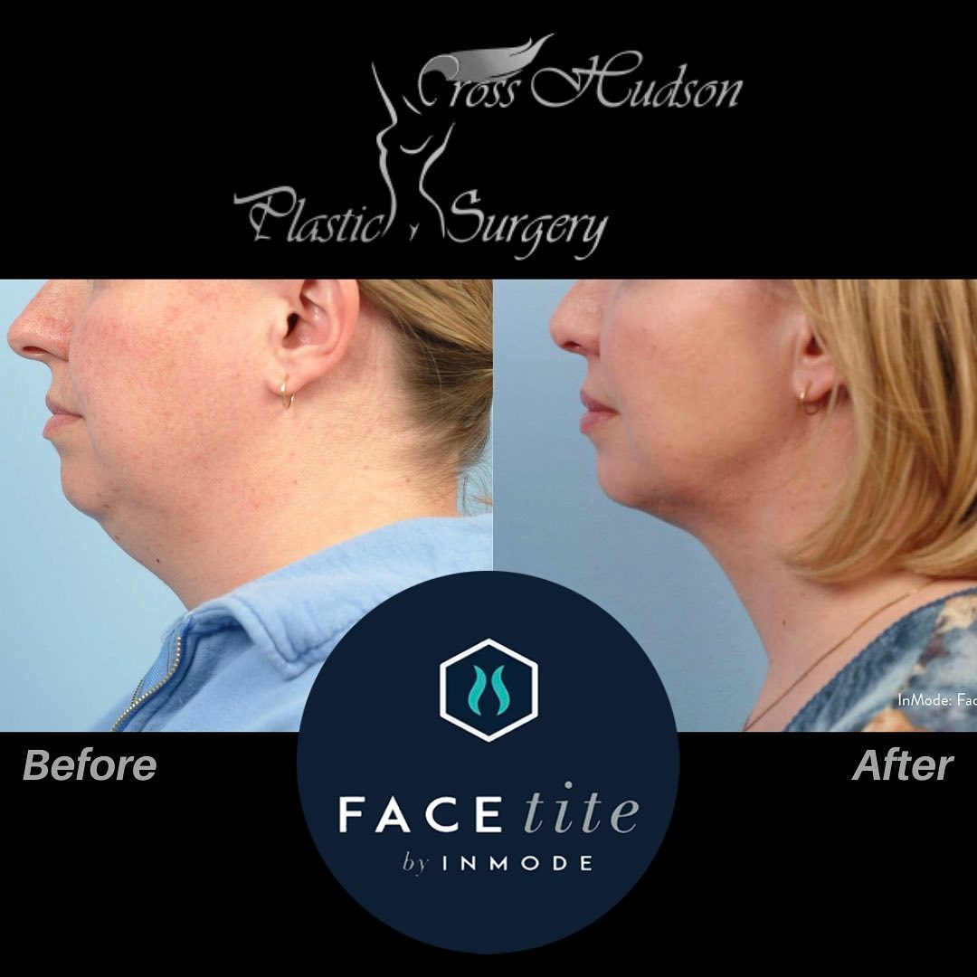 Before & After Gallery: Facetite Banner