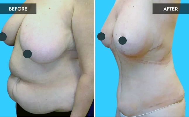 Before & After Gallery: Breast Surgery