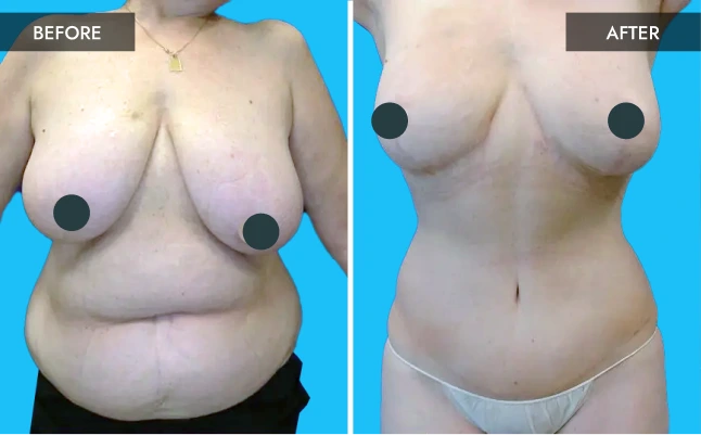 Before & After Gallery: Breast Surgery