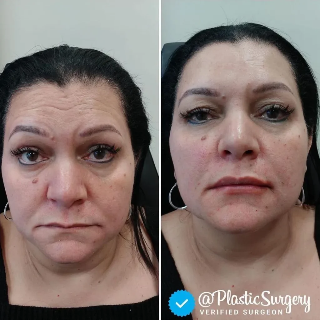 Before and After Gallery: Fillers