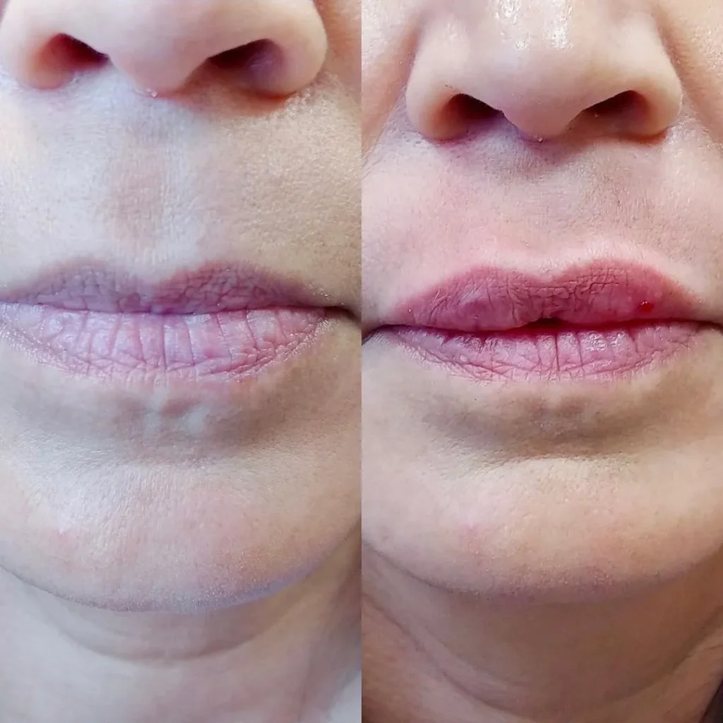 Before and After Gallery: Fillers